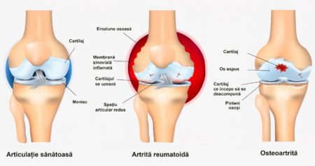 cum să tratezi osteoartrita genunchiului