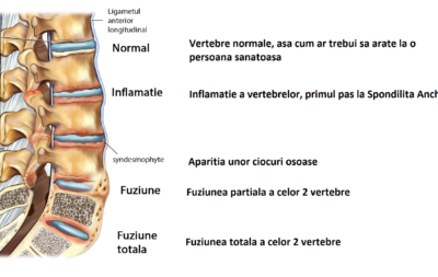 spondilita_photo