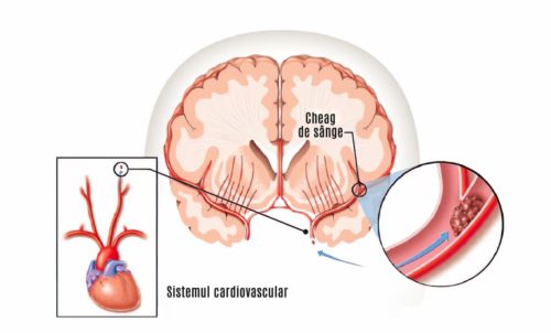 avc ischemic