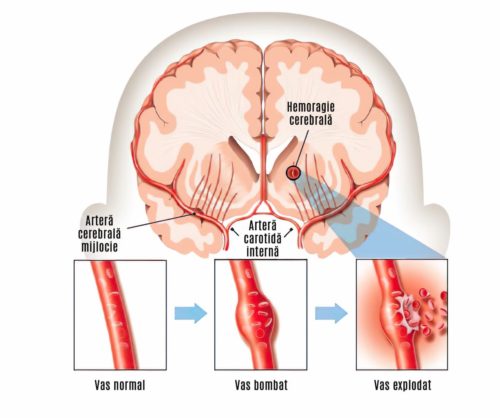 hemoragie intracerebrala