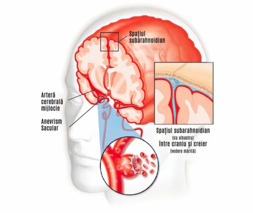 hemoragie subarahnoidiana
