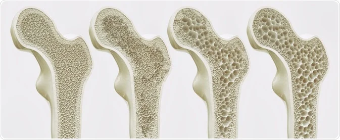 Osteo